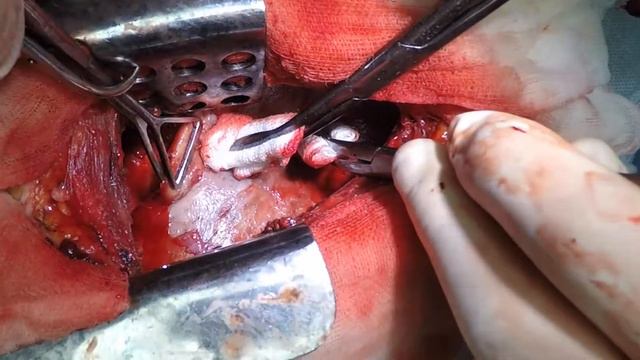 Декортикация свищ смотреть онлайн