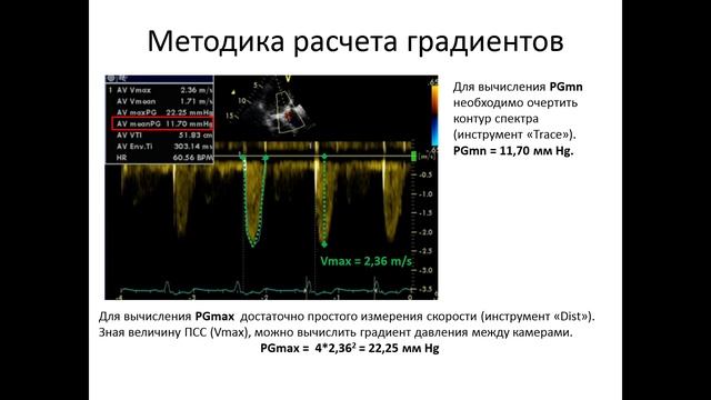 Основы эхокардиографии: ГРАДИЕНТ ДАВЛЕНИЯ смотреть онлайн