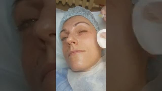 Биоревитализация в салоне Orlova Beauty. Красноярск. смотреть онлайн