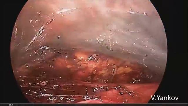LAPAROSCOPIC RETROPERITONEAL LYMPH NODE DISSECTION - extraperitoneal approach смотреть онлайн