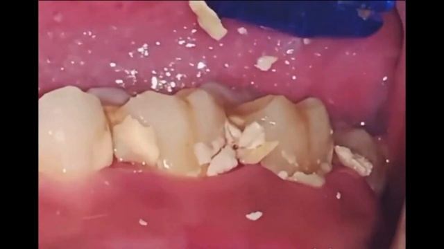 удаления зубного камня смотреть на ютуб _tartar removal watch on youtube смотреть онлайн