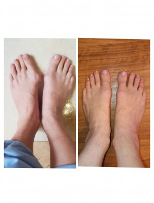 Халюс Вальгус. Hallux valgus «Шишка на большом пальце».mp4