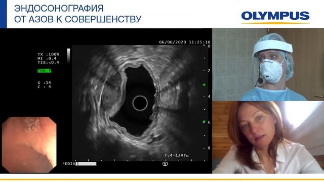 Диагностическая эндосонография неэпителиального образования стенки желудка. Е. Н. Солодинина смотреть онлайн