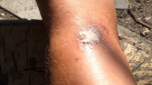 Чем обработать гнойную рану , лучший антисептик и самый доступный