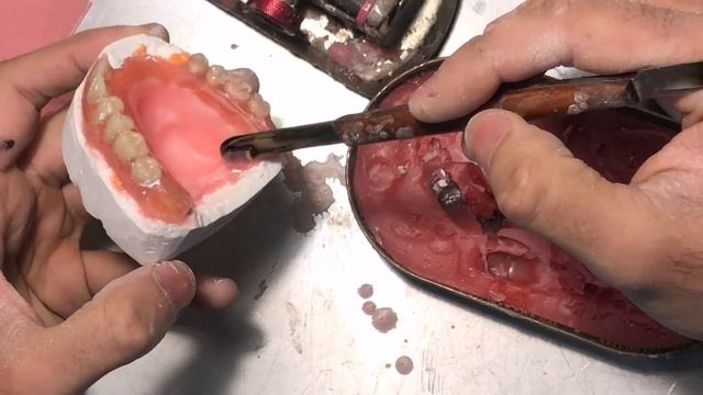 Съемный протез перебазировка смотреть онлайн