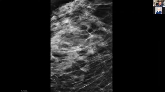 Approach to Mammogram Beyond the Basics смотреть онлайн