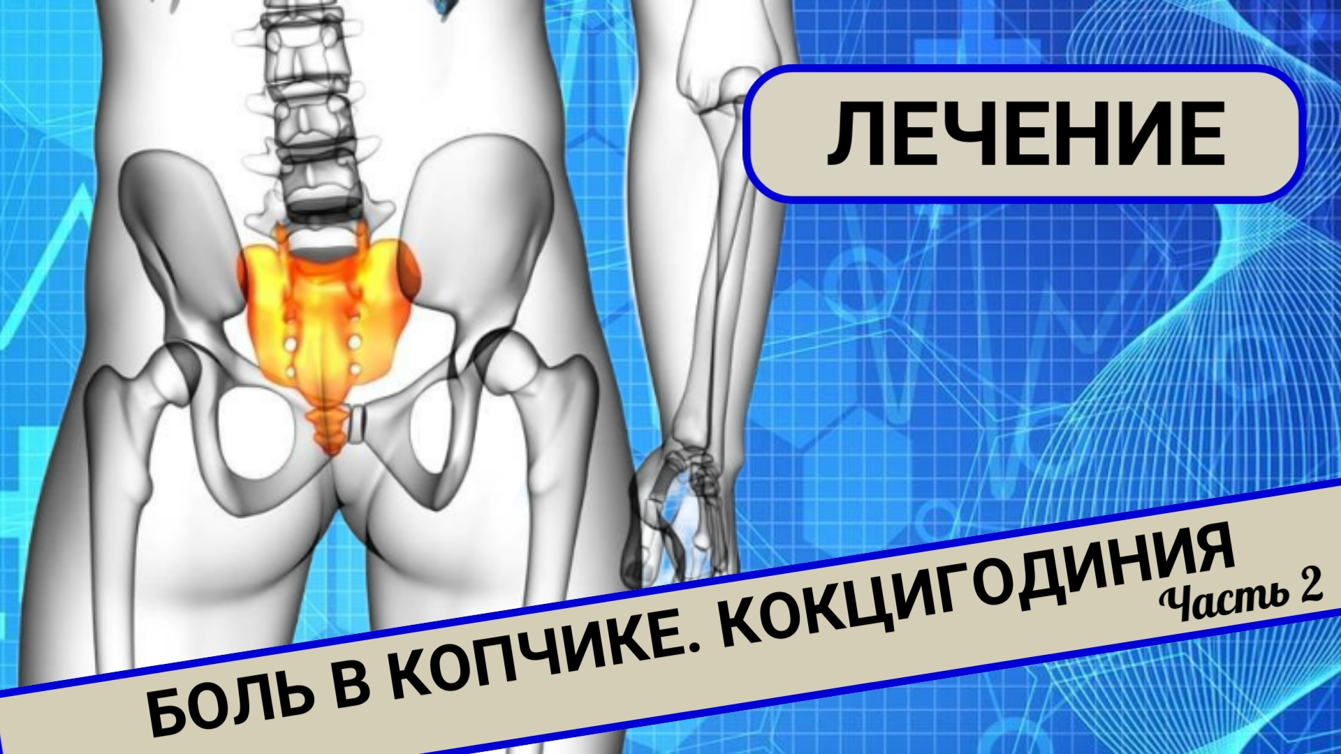 БОЛИТ КОПЧИК. Кокцигодиния. Лечение. (Часть 2) смотреть онлайн