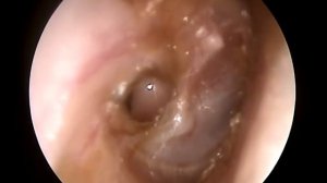 Перфорация барабанной перепонки