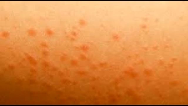 Как идентифицировать Сыпь ВИЧ смотреть онлайн