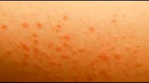 Как идентифицировать Сыпь ВИЧ