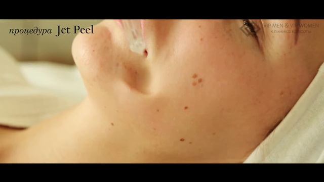 Jet Peel. Пилинг в любое время года.