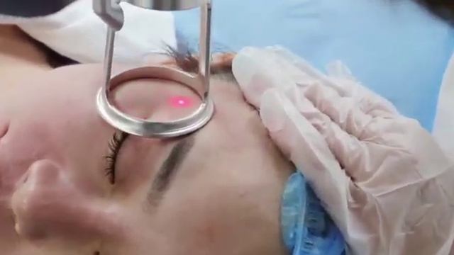 Фракционный CO2 лазер HONKON-10600ZHb (Видео 1)