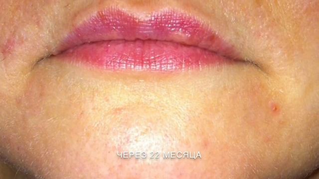 Результат после электроэпиляции смотреть онлайн