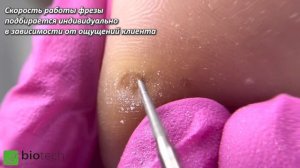 УДАЛЕНИЕ СТЕРЖНЕВОЙ МОЗОЛИ/ИСПОЛЬЗОВАНИЕ КЕРАТОЛИТИКА ПРИ УДАЛЕНИИ МОЗОЛЕЙ