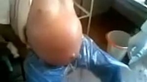 Лапароцентез при асците