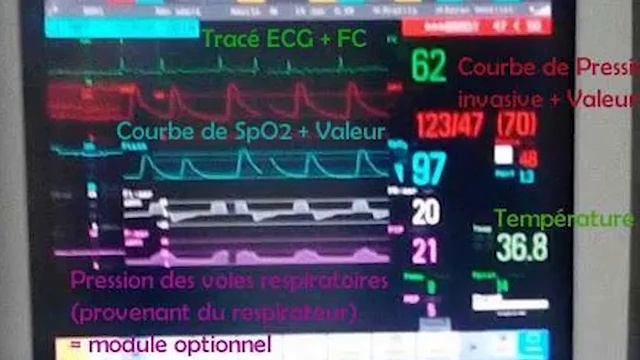 FORMATION PRATIQUE EN RÉANIMATION (Installation d'un scope moniteur de surveillance) смотреть онлайн