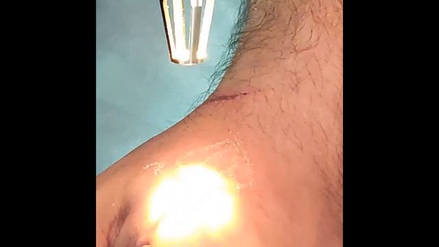 Удаление татуировки лазером смотреть онлайн