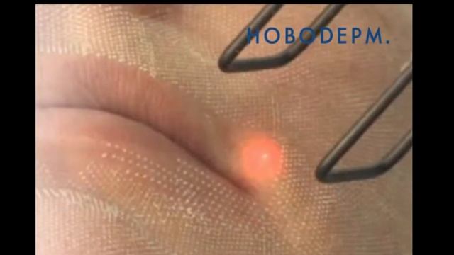 Лезерне шліфування в Новодерм смотреть онлайн