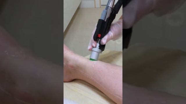 Лазерная эпиляция Moveo смотреть онлайн