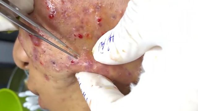 Removes Acne | Давим прыщи | чёрные точки | Залипательно 2022