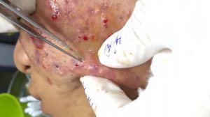 Removes acne | Давим прыщи | чёрные точки | Залипательно 2022