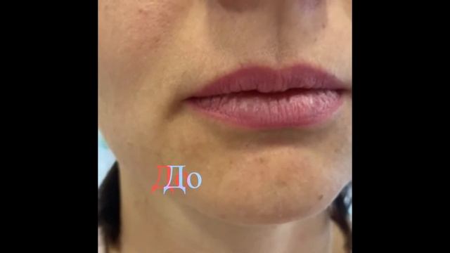 ❣️??Биоревитализация губ❗️ смотреть онлайн