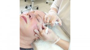 Инъекции Белотеро Софт - биоревитализация