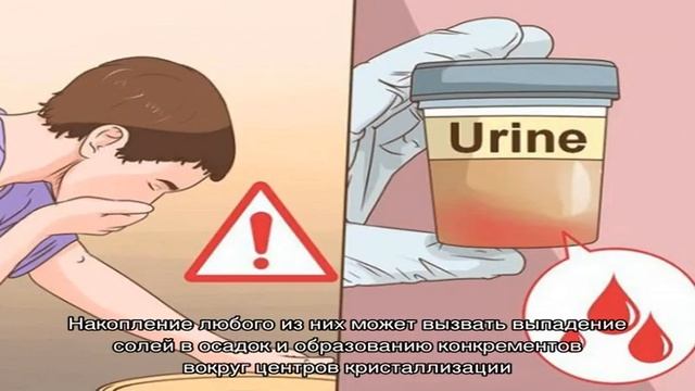 Камни в почках смотреть онлайн