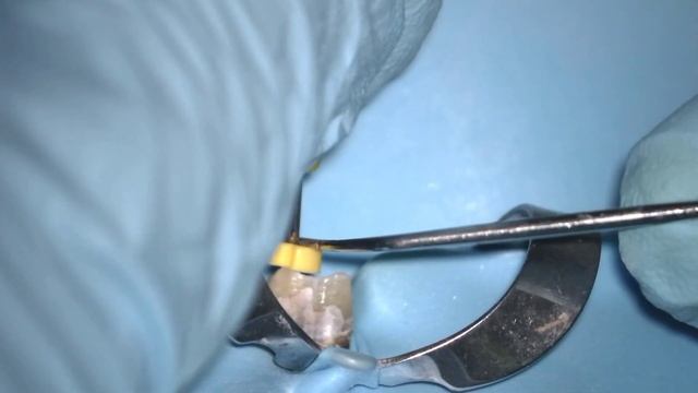 Root Canal Redo #7 смотреть онлайн