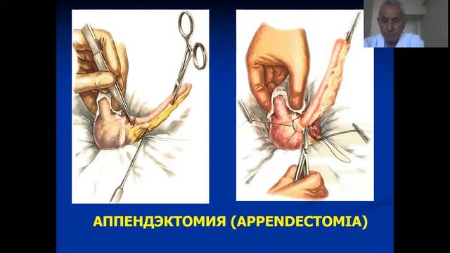 Острый живот смотреть онлайн
