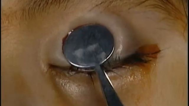Incision and drainage of upper lid chalazion смотреть онлайн