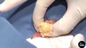 Выдавливание огромного прыща на шее пожилого мужчины! Очень много подкожного желтого жира! Мерзость