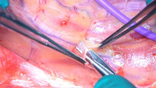 Anterolateral thigh (ALT) free flap harvest смотреть онлайн