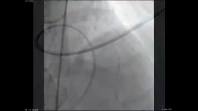 Тромбаспирация и стентирование ПНА смотреть онлайн