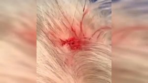 подборка выдавливания прыщей 5 II выдавливание прыщей