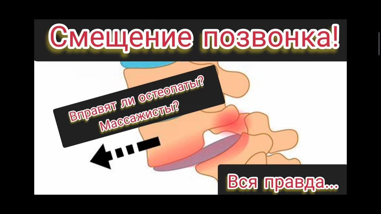 Смещение позвонка! Может ли вправить остеопат? Массажист? Тренер?/ Спондилолистез разбор МРТ смотреть онлайн