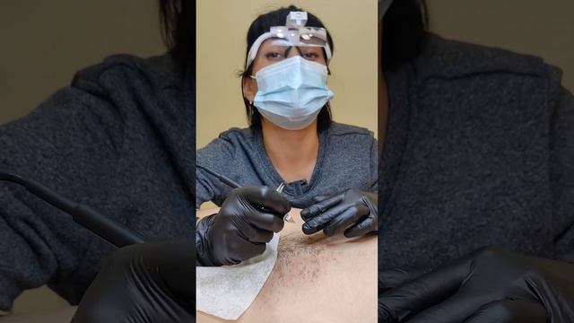 Электроэпиляция смотреть онлайн