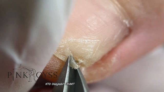 Сломала ноготь, и он начал вростать, что приносило клиенту дискомфорт при хотьбе. смотреть онлайн