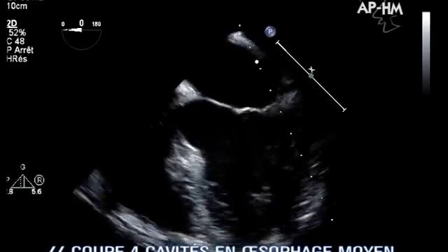 Echographie Trans Oesophagienne ETO смотреть онлайн