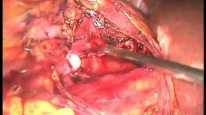 Лапароскопическая пластика ЛМС по Хайнс Андерсену с резекцией лоханки