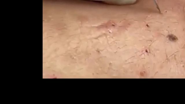 Giant Pimple & Popping Huge Blackheads Best Pimple Popping 15 смотреть онлайн