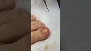 Лечение вросшего ногтя и установка скобы (видео 4) - Подолог Елена Баскова