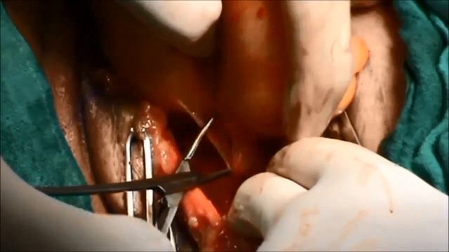 Supraclavicular Lipoma Excision смотреть онлайн