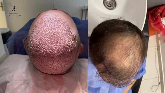 hair transplant 5000 grafts in Bellus clinic, Istanbul / Turkey смотреть онлайн