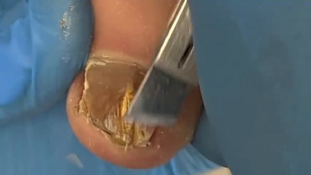 Uncle's stubborn onychomycosis, clean up excess ingrown nails【Xue Yidao】 смотреть онлайн