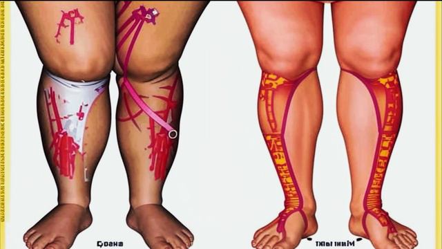 Чем опасен лишний вес? смотреть онлайн