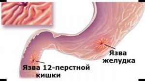 Выделение крови из заднего прохода. Примесь крови