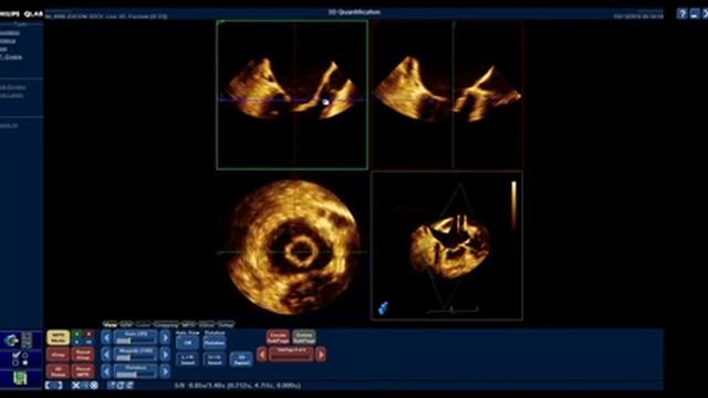 How to assess the mitral valve area using 3D Echocardiography смотреть онлайн