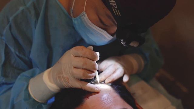 Hair Transplant with Minimal Downtime at Veritas - A Doctor's Experience смотреть онлайн