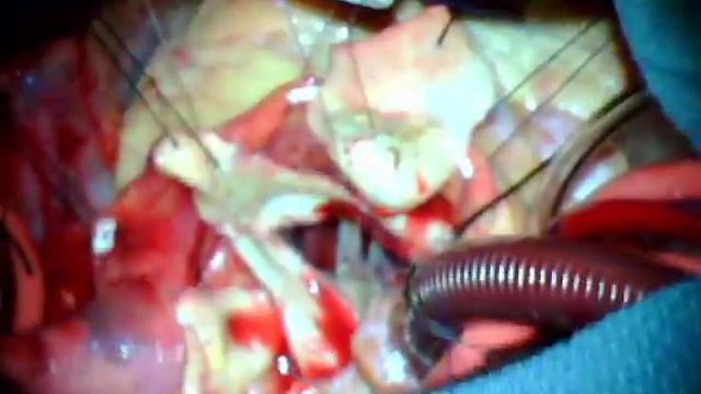 Aortic Valve Root Reconstruction And Aneurysm Repair